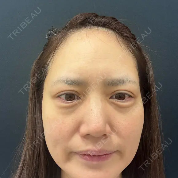クマ治療 湘南美容クリニック 西葛西院 BEFORE メイン用