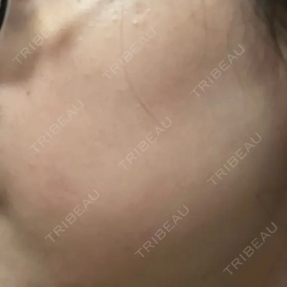 ピーリング（ニキビ・毛穴） 大美会クリニック 梅田院 BEFORE メイン用