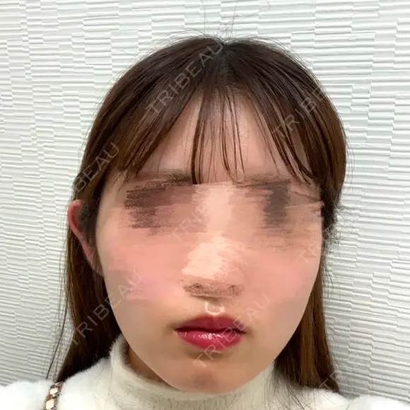 脂肪吸引（顔） TCB東京中央美容外科 新横浜院 BEFORE メイン用