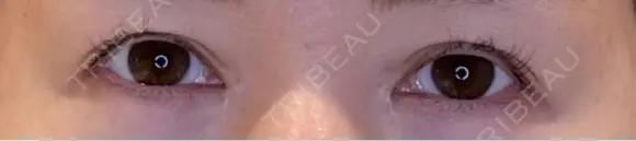 目尻切開 / タレ目形成・グラマラスライン（埋没） LOUIS CLINIC 二子玉川院【ルイクリニック】 BEFORE メイン用