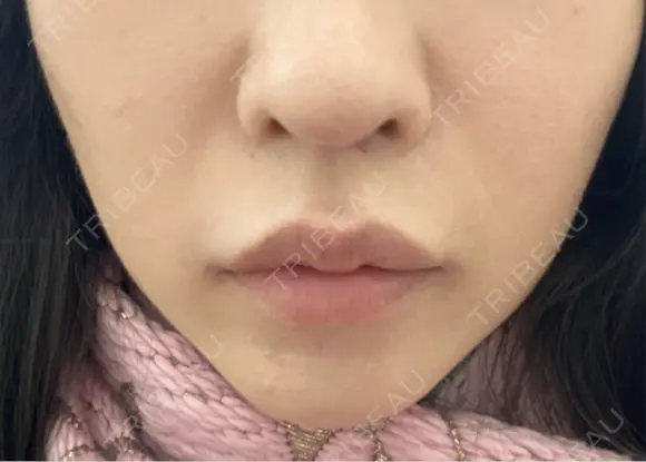 ヒアルロン酸注入（唇） / ヒアルロン酸注入（鼻翼基部） BiBiクリニック BEFORE メイン用