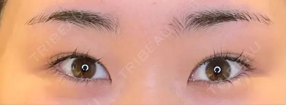 目尻切開 / タレ目形成・グラマラスライン（埋没） LOUIS CLINIC 二子玉川院【ルイクリニック】 BEFORE メイン用
