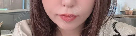 ヒアルロン酸注入（唇） / ピーリング（ニキビ・毛穴） / ルメッカ ルラ美容クリニック 名古屋栄院 / ルラスキンクリニック 名古屋栄院 BEFORE メイン用