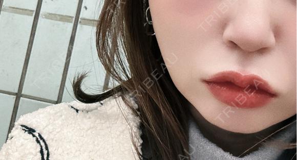 ヒアルロン酸注入（あご） / ルメッカ Code Beauty Clinic 名古屋院 BEFORE メイン用