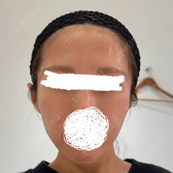 脂肪注入（額） EMMA CLINIC（エマクリニック） BEFORE メイン用