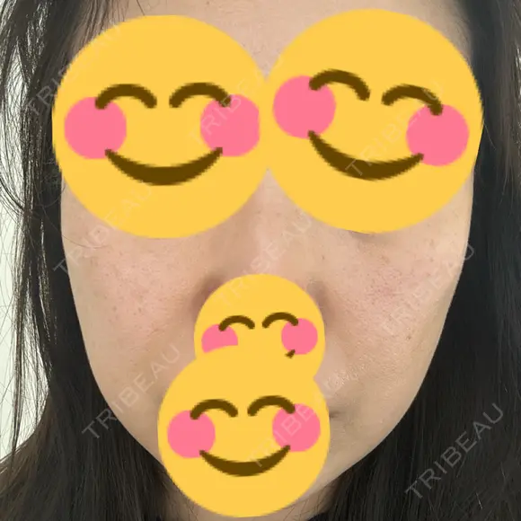 リジュラン ミニマムスキンクリニック池袋 BEFORE メイン用