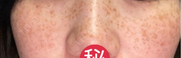 ルメッカ MIO CLINIC 梅田院 BEFORE メイン用