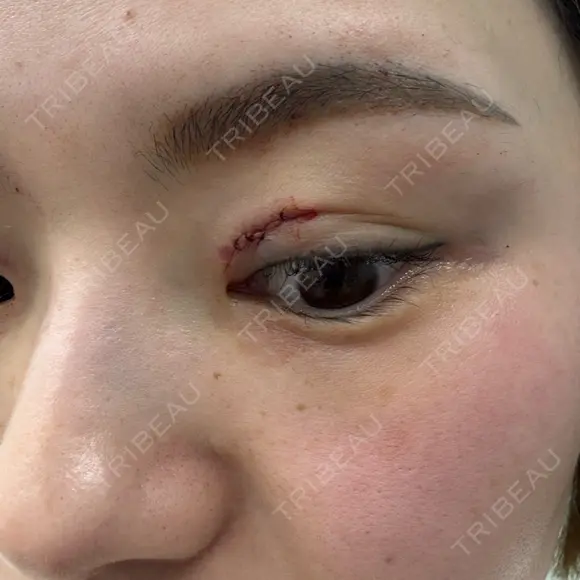 目頭切開 / その他（目元） Leap beauty clinic BEFORE メイン用