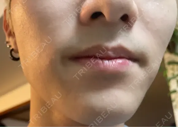 ボトックス（エラ・小顔） TCB東京中央美容外科 新宿三丁目院 BEFORE メイン用