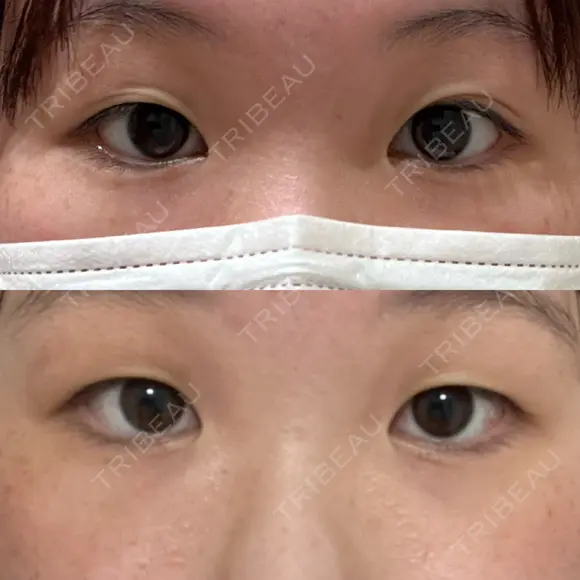 二重切開 / 眼瞼下垂（切開） / 上まぶたたるみ取り ユア美容クリニック 福岡院 BEFORE メイン用