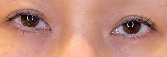 目尻切開 / タレ目形成・グラマラスライン（埋没） LOUIS CLINIC 二子玉川院【ルイクリニック】 BEFORE メイン用