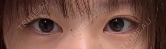 二重埋没 9BeautyClinic BEFORE メイン用