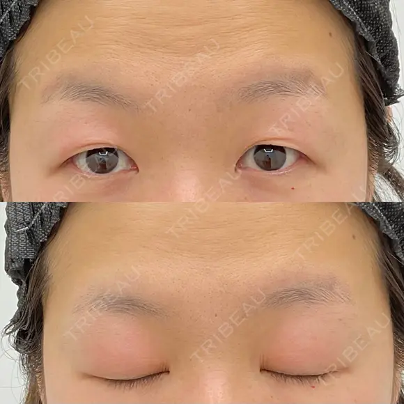 二重切開 / 上まぶたたるみ取り / 上まぶたの脂肪取り VIDA BEAUTY CLINIC BEFORE メイン用
