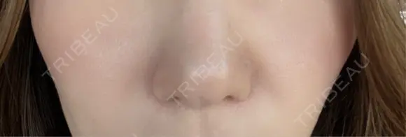 ヒアルロン酸注入（鼻翼基部） KIMI CLINIC 形成・美容外科 BEFORE メイン用