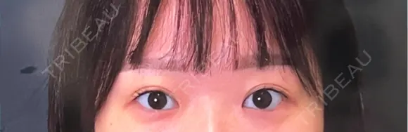 ヒアルロン酸注入（涙袋） 銀座美容外科クリニック 銀座院 BEFORE メイン用