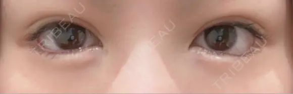 二重切開 / 眼瞼下垂（切開） ユア美容クリニック 福岡院 BEFORE メイン用