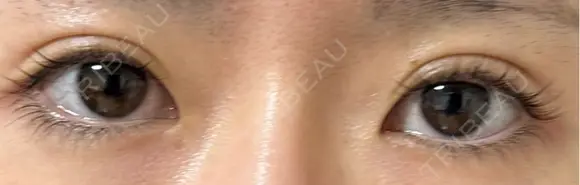 目頭切開 9BeautyClinic BEFORE メイン用