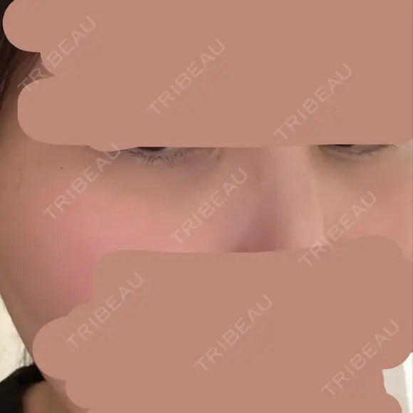 ヒアルロン酸注入（涙袋） / ヒアルロン酸注入（唇） PRO CLINIC プロクリニック 銀座院 BEFORE メイン用