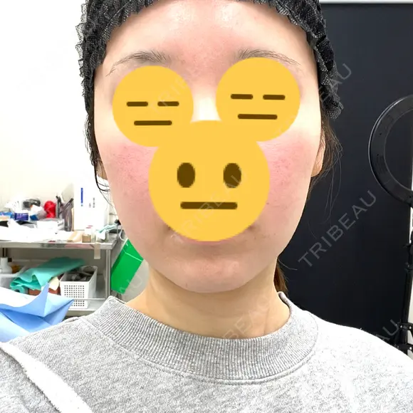 脂肪吸引注射（顔） ルラ美容クリニック 名古屋栄院 / ルラスキンクリニック 名古屋栄院 BEFORE メイン用