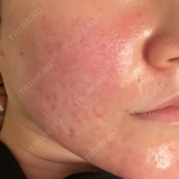 肌育注射（ジュベルックなど） / その他（肌） 大美会クリニック 京都烏丸院 BEFORE メイン用