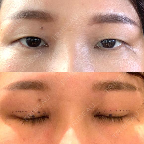 二重埋没 聖心美容クリニック 札幌院 BEFORE メイン用