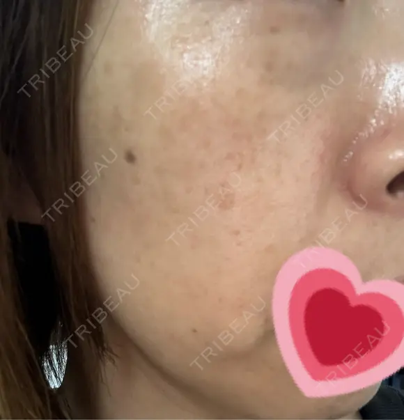 ルメッカ ルラ美容クリニック 札幌本院 BEFORE メイン用