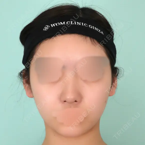 鼻尖形成（切開） / 軟骨移植 / 骨切幅寄せ / ワシ鼻修正・ハンプ切除 WOM CLINIC GINZA （ワム クリニック ギンザ） BEFORE メイン用