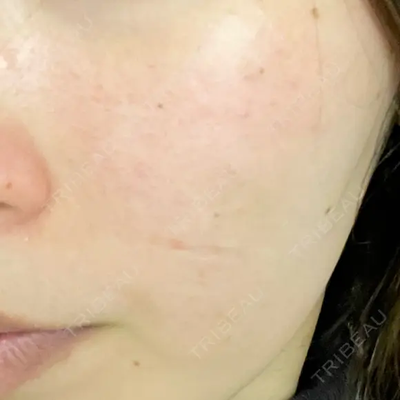 ポテンツァ 上野美容外科・美容皮膚科 BEFORE メイン用