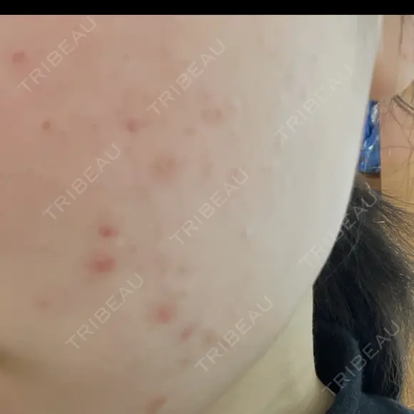 ピーリング（ニキビ・毛穴） 大美会クリニック 梅田院 BEFORE メイン用