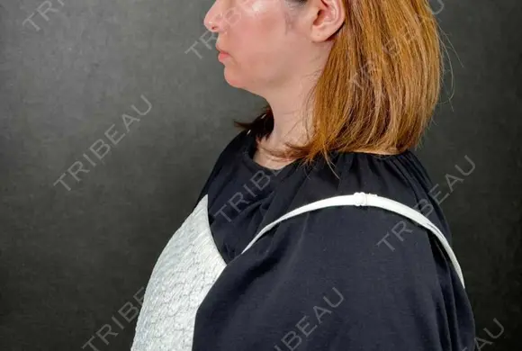 糸リフト / 脂肪吸引（顔） / ネックリフト ネビュラクリニック 京都院 BEFORE メイン用