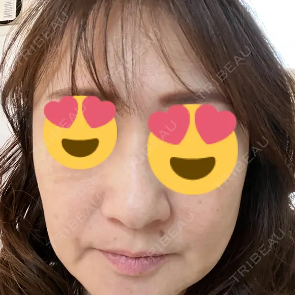ボトックス（額） / ピーリング（ニキビ・毛穴） / イオン導入 CHARIS BEAUTY CLINIC BEFORE メイン用