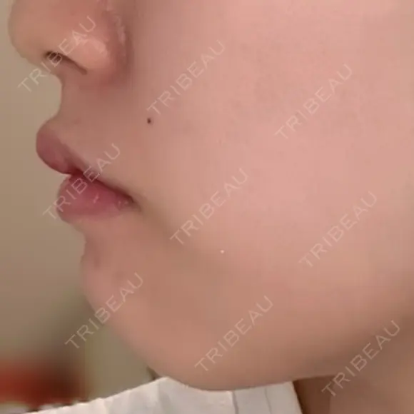 ボトックス（額） ルラ美容クリニック銀座院 BEFORE メイン用