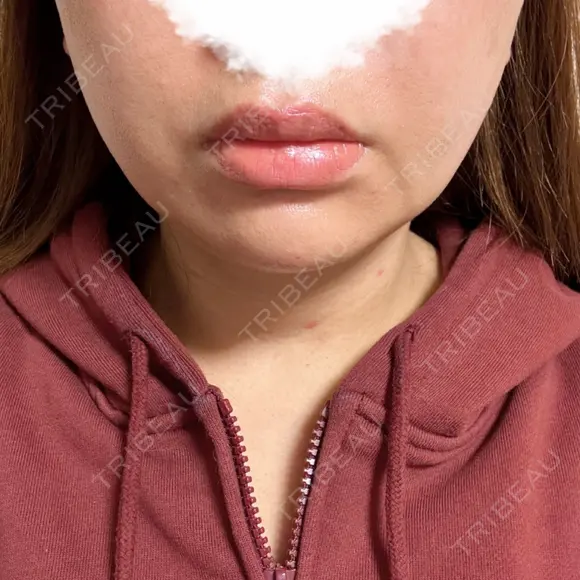糸リフト / 脂肪吸引（顔） EMMA CLINIC（エマクリニック） BEFORE メイン用