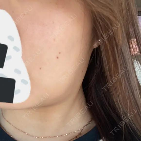 ルメッカ Belle Via Skin Clinic BEFORE メイン用