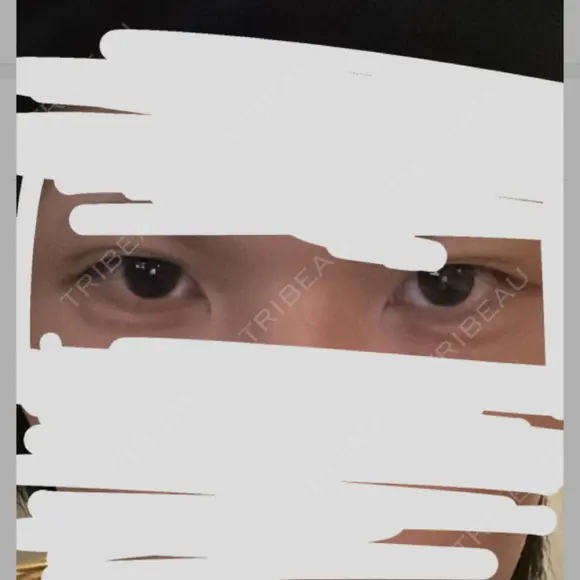 二重切開 / 目頭切開 池袋麗歯科・美容皮膚科 BEFORE メイン用