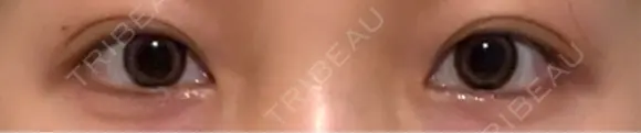 目尻切開 / タレ目形成・グラマラスライン（埋没） / ボトックス（エラ・小顔） LOUIS CLINIC 二子玉川院【ルイクリニック】 BEFORE メイン用