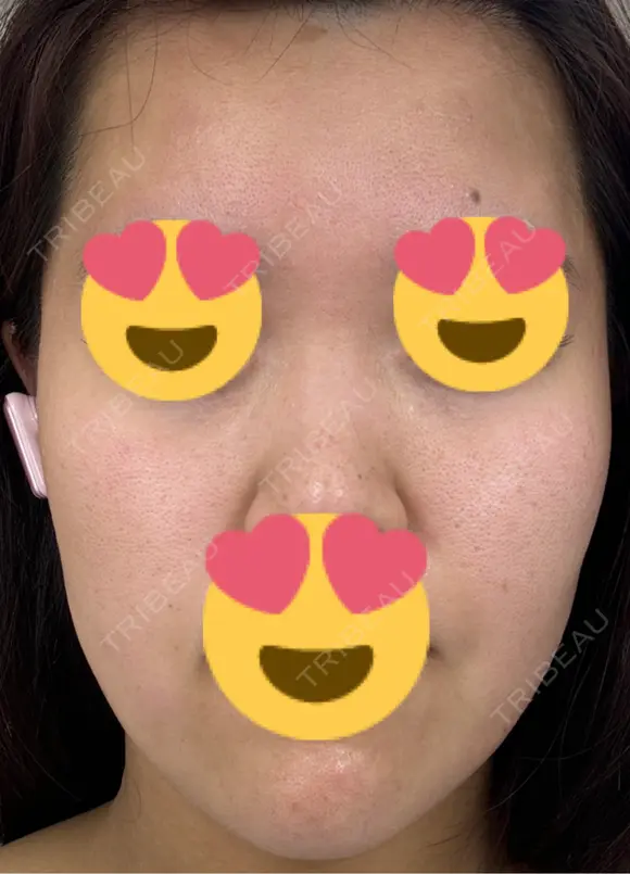 医療脱毛（顔） 日本美容・医療クリニック 六本木院 BEFORE メイン用