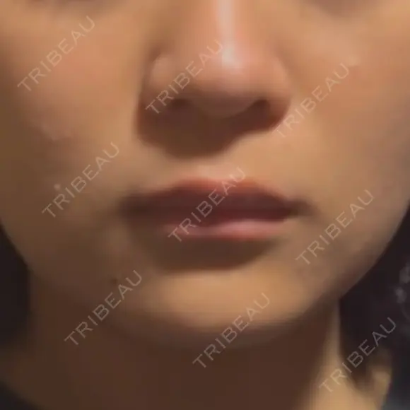 二重埋没 / 糸リフト / 脂肪吸引注射（顔） / ヒアルロン酸注入（涙袋） / 肌ヒアルロン酸注入（たるみ・シワ改善） / ヒアルロン酸注入（あご） / ボトックス（エラ・小顔） / ヒアルロン酸注入（唇） / ボトックス（口角） / シワ取りボトックス / その他（鼻） / その他（口元） TCB東京中央美容外科 熊本院 BEFORE メイン用