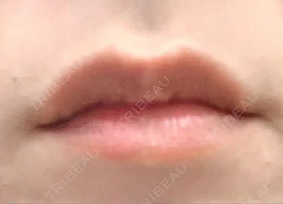 ヒアルロン酸注入（唇） / ボトックス（口角） id美容クリニック 銀座院 BEFORE メイン用