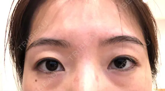 眉下切開 ビクアスクリニック BEFORE メイン用