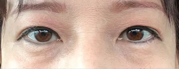 二重埋没 / ヒアルロン酸注入（目の下） アーティスクリニック 博多 BEFORE メイン用