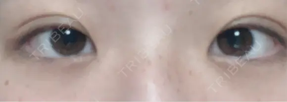 ヒアルロン酸注入（涙袋） Olino美容外科・美容皮膚科 BEFORE メイン用