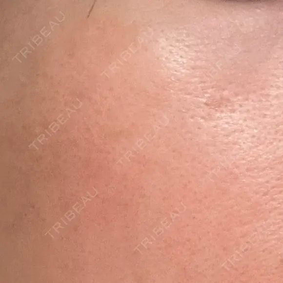 ニードルRF（ポテンツァなど） 広島プルミエクリニック BEFORE メイン用