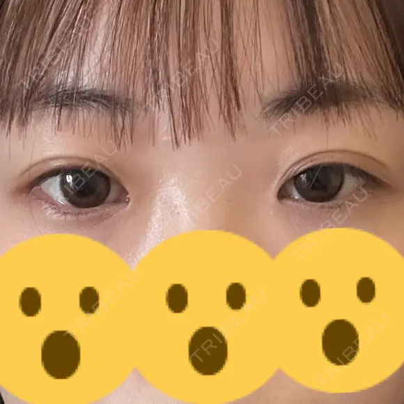 二重埋没 / 眼瞼下垂（非切開） OMI CLINIC 【オミクリニック】 BEFORE メイン用