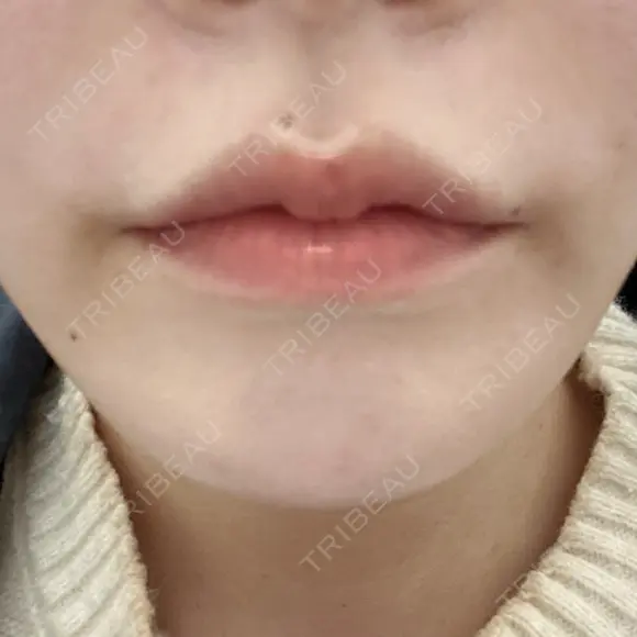 ボトックス（口角） / ボトックス（額） / ハイフ（顔） TCB東京中央美容外科 広島院 BEFORE メイン用