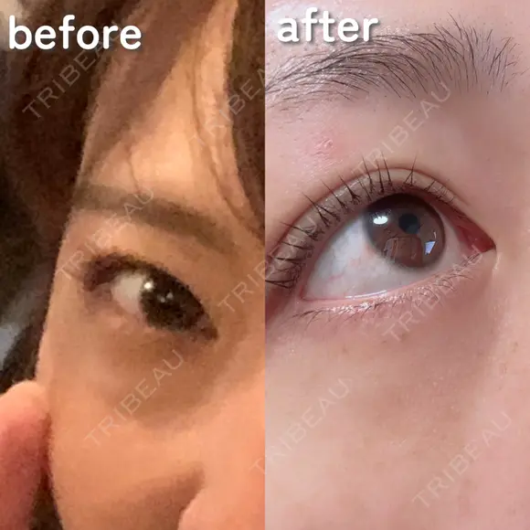 クマ治療 PRISM Beauty Clinic 町田院 BEFORE メイン用