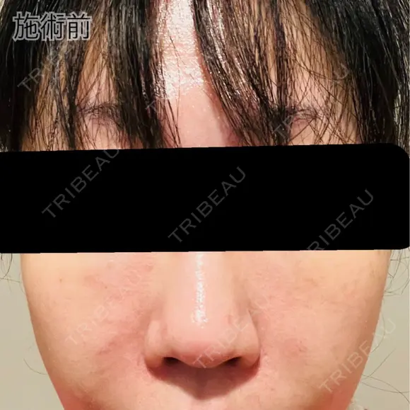 肌育注射（ジュベルックなど） / リジュラン 新宿Ladies&Gentlemen美容クリニック BEFORE メイン用