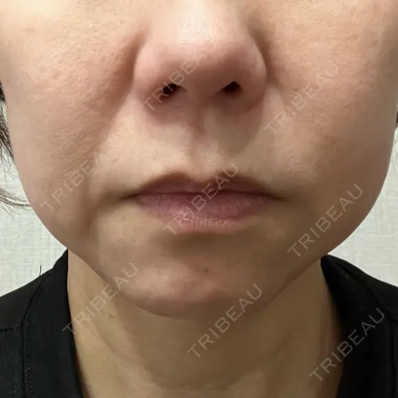 RF（高周波）たるみ治療 大美会クリニック 心斎橋本院 BEFORE メイン用