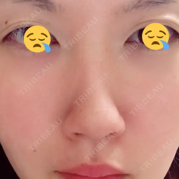 鼻尖形成（切開） / 軟骨移植 白山クリニック 大分 BEFORE メイン用