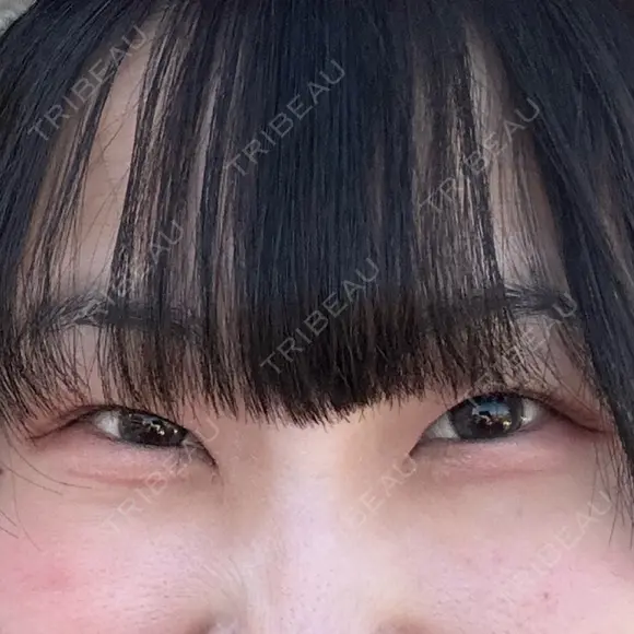 二重埋没 / 目頭切開 / 上まぶたの脂肪取り HAAB×DREAM BEAUTY CLINIC 東京本院 BEFORE メイン用